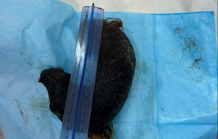 Тульские врачи удалили из желудка 12-летней девочки 750-граммовый комок волос