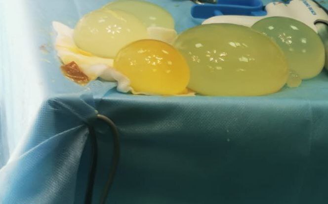 У 48-летнего туляка вырос огромный живот из-за ленточных червей