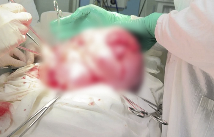 В Тульской области пациентке удалили гигантскую миому матки весом более 14 кг