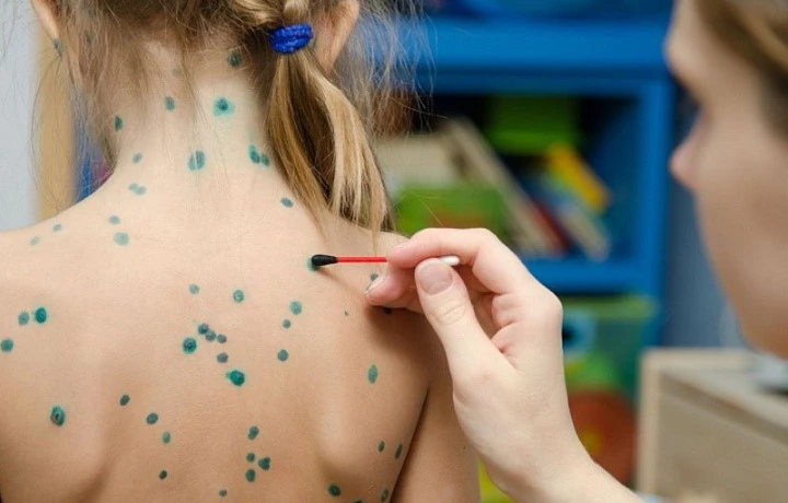 В Тульской области пять лет подряд растет заболеваемость ветрянкой