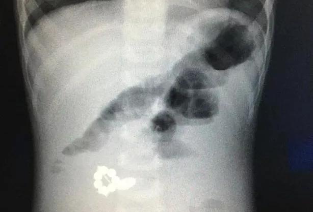 Тульские врачи спасли полуторагодовалого ребенка, проглотившего батарейку и магниты