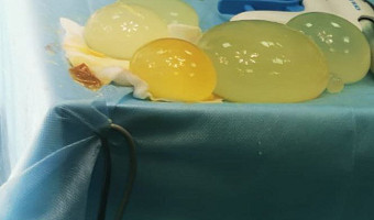 У 48-летнего туляка вырос огромный живот из-за ленточных червей