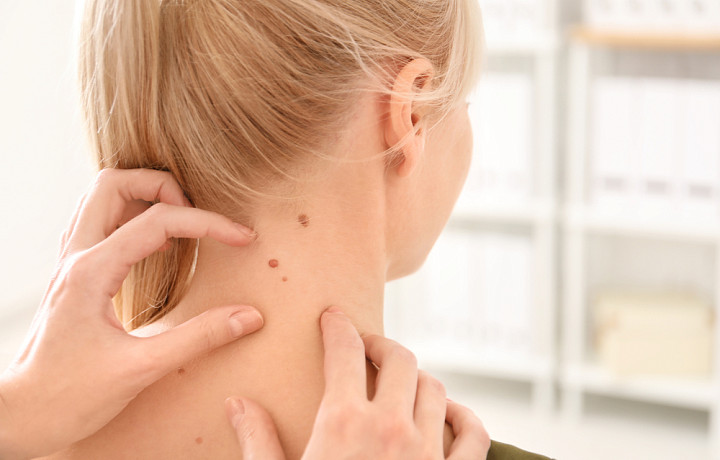 Врач Карвацкая назвала главную причину развития рака кожи