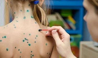 В Тульской области пять лет подряд растет заболеваемость ветрянкой