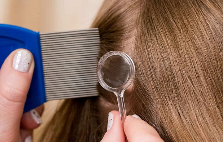 Число случаев педикулёза выросло на 23% в Тульской области с начала года