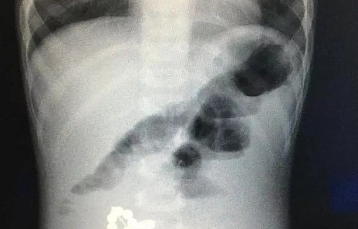 Дышите – не дышите: за полгода в Тульской области 227 случаев проглатывания инородных предметов – как оказать первую помощь