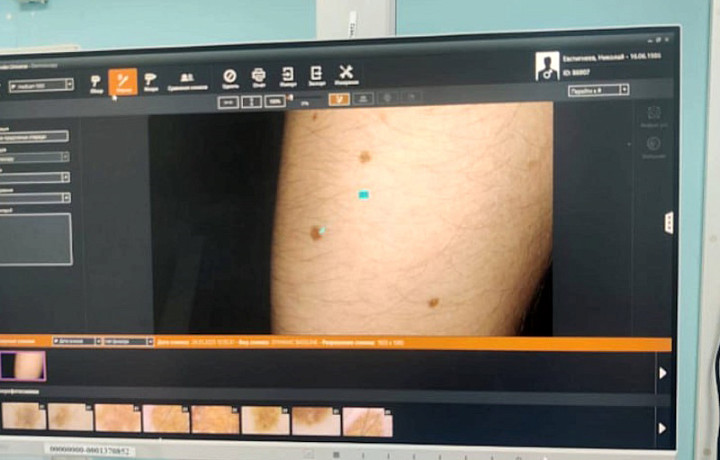 С начала года тульские врачи выявили 30 случаев меланомы