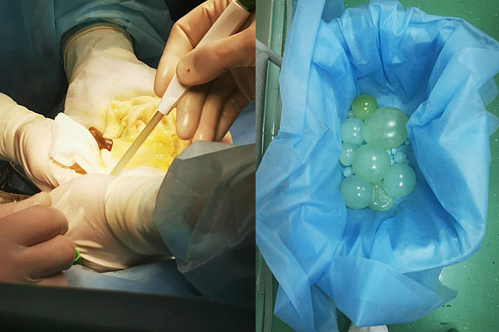 У 48-летнего туляка вырос огромный живот из-за ленточных червей