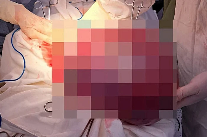 Опухоль размером с арбуз, магниты в желудке и огромный живот из-за ленточных червей: какие уникальные операции провели медики Тульской области в 2025 году